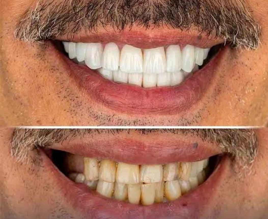 Restauration de dents très détériorées