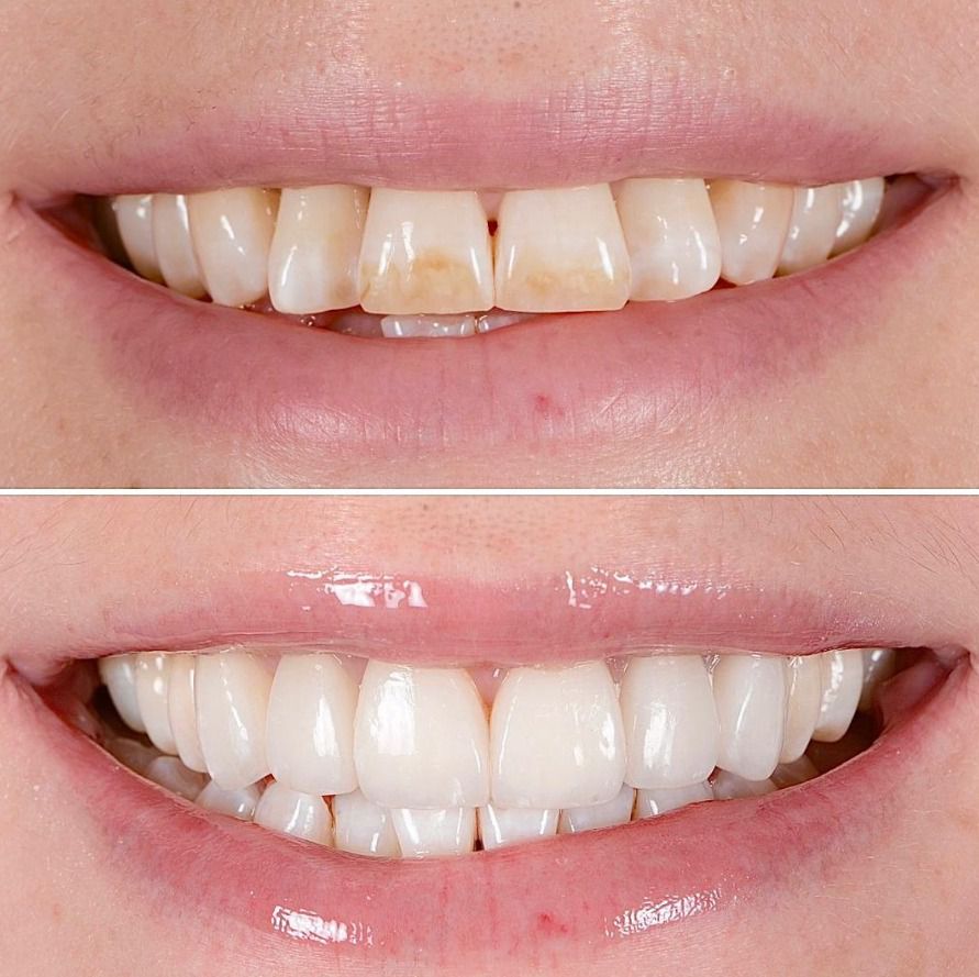 Hollywood Smile