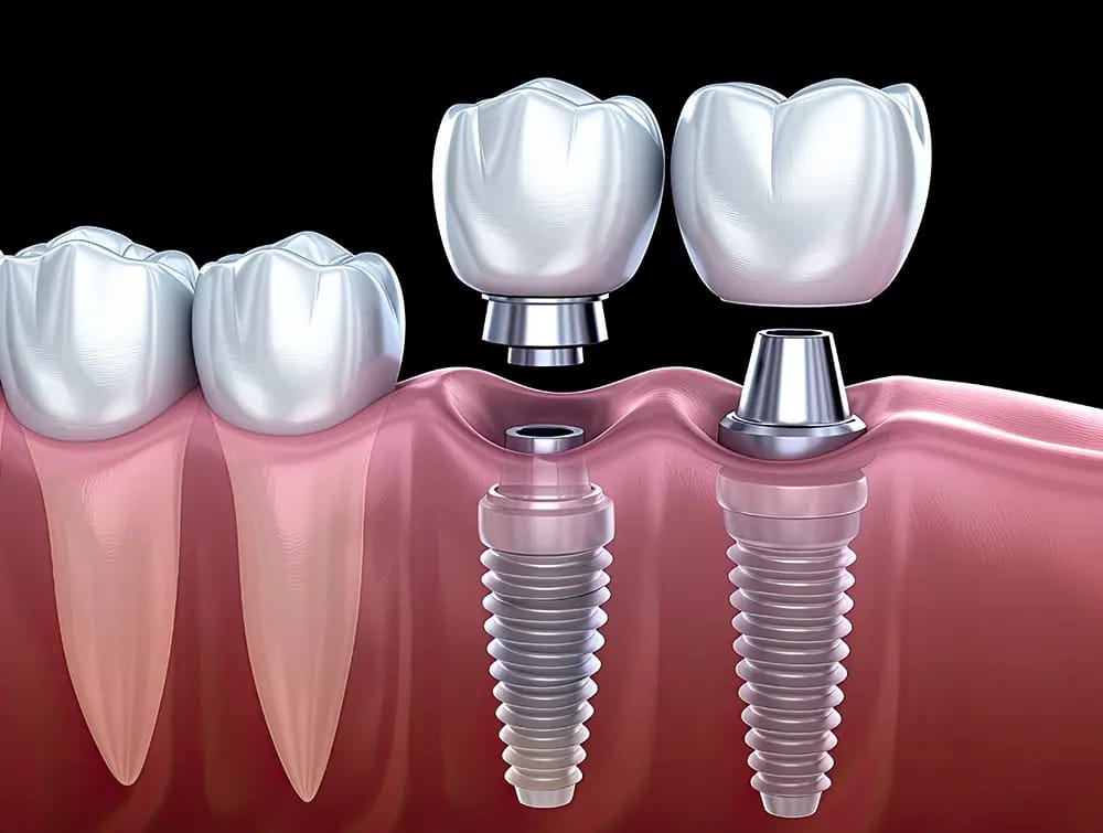 Implants Dentaires
